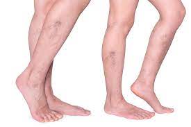 LE VENE VARICOSE POSSONO SALVARTI LA VITA